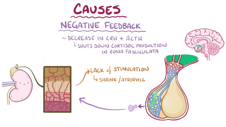 What is Cushing syndrome? Cushing syndrome is a condition characterized by long-term exposure to high cortisol levels. 
Sources:
● Pathoma 2017
● First Aid 2017
● Robbins Pathology, 9th edition
● Harrison’s Endocrinology
● UpToDate
● http://emedicine.medscape.com/article/921086-overview
● http://eme