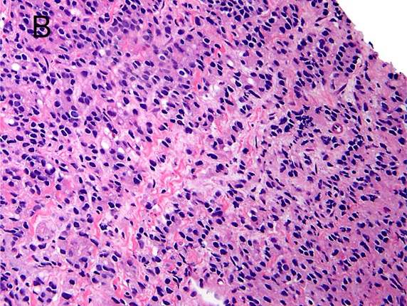 Micrograph of prostate cancer with Gleason score 10 (5+5) with cords of cells