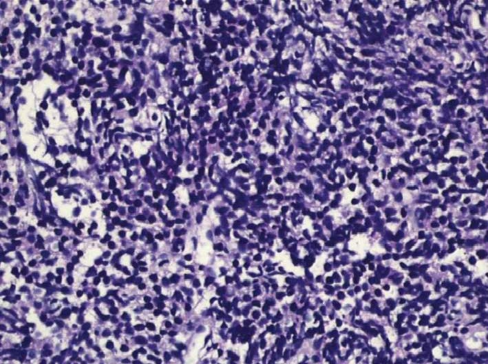 Biden Prostate Cancer Diagnosis Draws Attention to a Disease Affecting Millions of Men