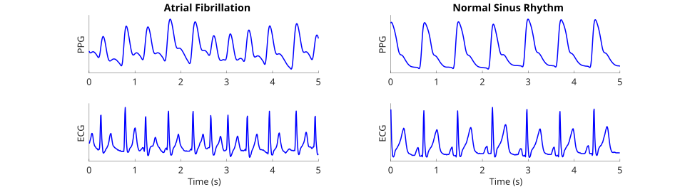 Atrial fibrillation vs. normal sinus rhythm: Photoplethysmogram (PPG, upper) and electrocardiogram (ECG, lower) signals in atrial fibrillation (left) and normal sinus rhythm (right). 
Additional files available here

Source: Data from the Listen dataset