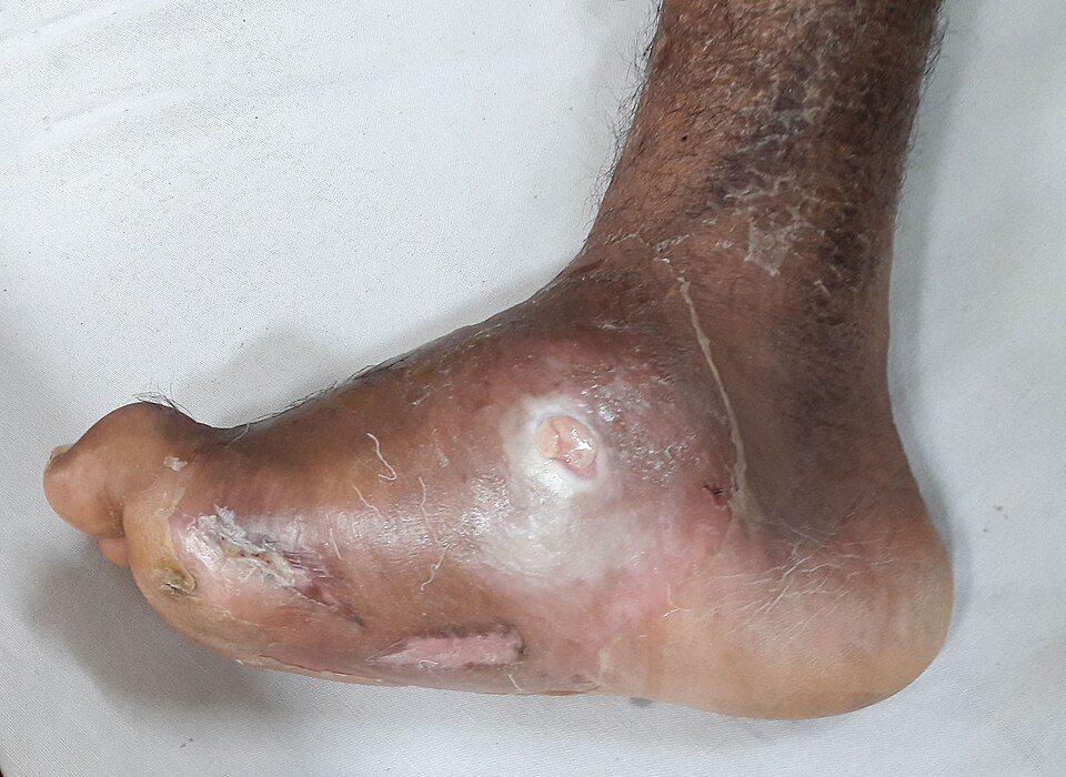This is an image of diabetic Charcot foot deformity with an ulcerated abscess (Diabetic Foot). The image was taken after the consent from the patient himself. Visit the video: Doctors hub
