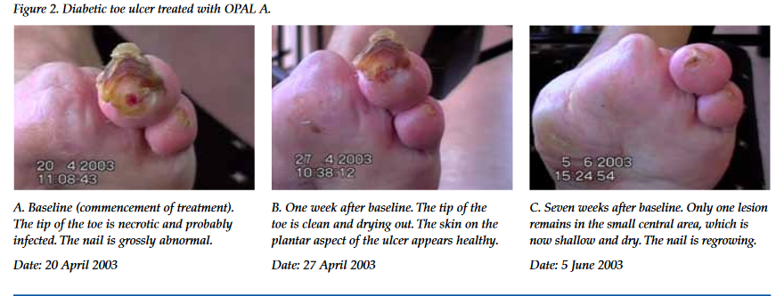 Smartphone Thermal Imaging Tool Aims to Detect Diabetic Foot Ulcers Earlier