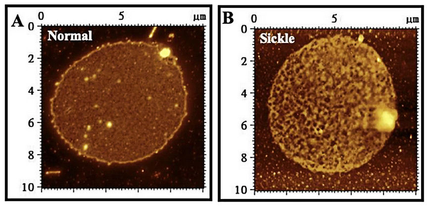 AFM topographical images of local structures of individual erythrocyte membrane ghosts fixed by glutaraldehyde. A A representative membrane ghost of normal erythrocytes. B A representative membrane ghost of erythrocytes from sickle cell anemia patients. From left to right panels: Entire membrane gho