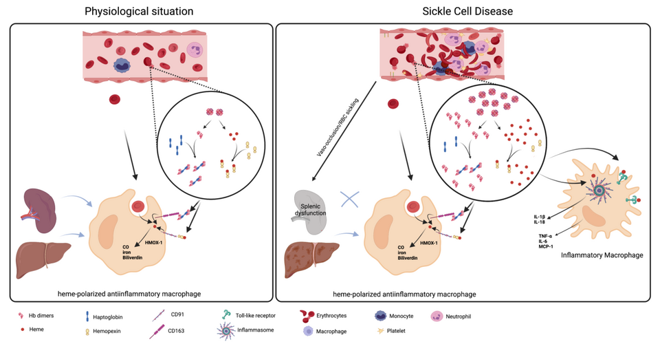 Figure 1. Macrophage clearance of red blood cells and hemoglobin products in sickle cell disease. Under normal physiological conditions, damaged or senescent erythrocytes are erythrophagocytosed extravascularly, primarily in the spleen. The elevation of intracellular heme during erythrophagocytosis