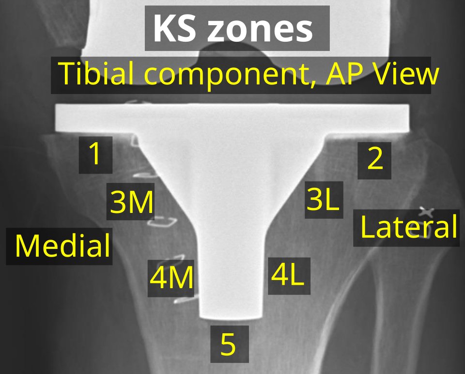 edit

Postoperative X-ray of normal knee prosthesis of a 73 year old man who had osteoarthritis. It shows KS zones (Knee Society, 2015). Reference:

 (2015). "Development of a Modern Knee Society Radiographic Evaluation System and Methodology for Total Knee Arthroplasty". The Journal of Arthroplasty