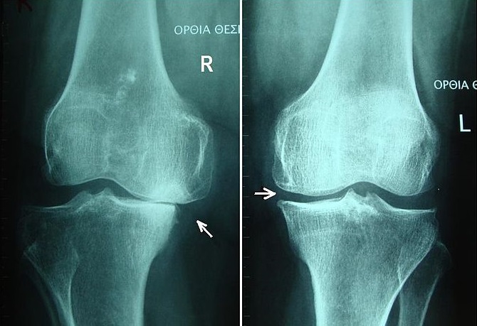Knee Osteoarthritis Affects More Than 30 Million Americans But Lifestyle Changes Can Help