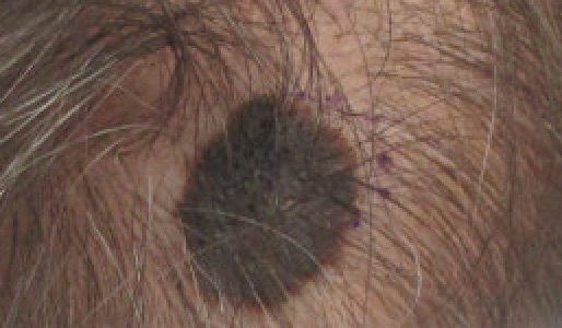 Personalized mRNA Melanoma Vaccine Beats Keytruda Alone in Phase 3 Trial