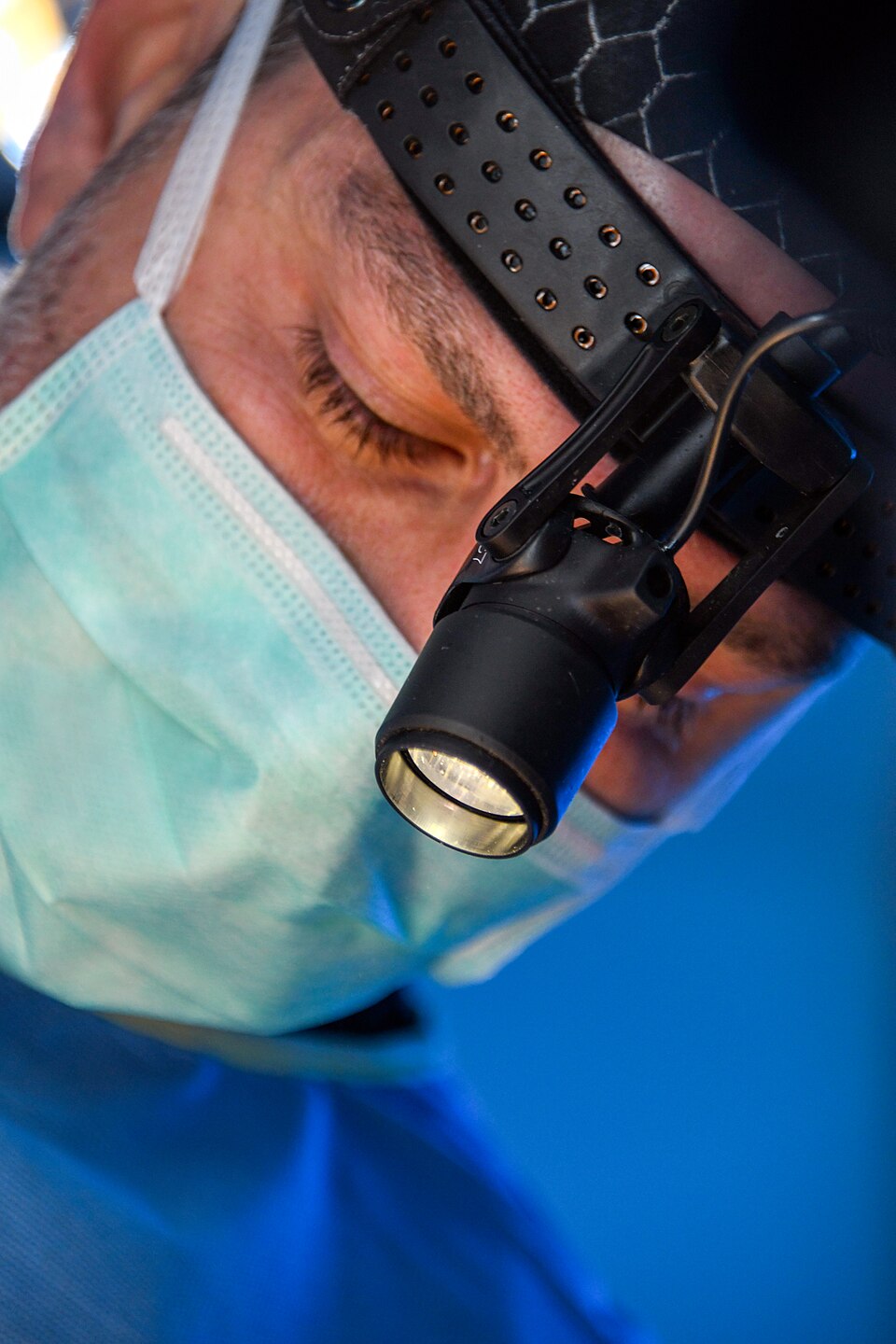 Intraoperative close-up showing a facial plastic surgeon wearing magnification loupes and a head-mounted surgical light during a procedure. These tools improve visualization and accuracy when working with delicate facial anatomy, supporting precise, anatomy-based surgical techniques. Image courtesy