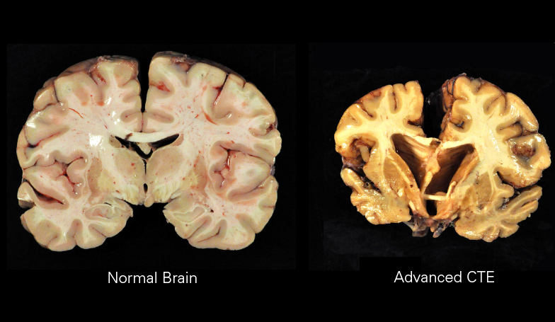 New Study Finds at Least One in Four Former NFL Players Had CTE