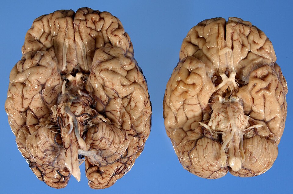 New Study Finds High Rate of CTE Among Former NFL Players