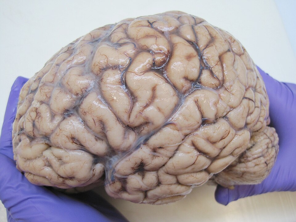 Brain autopsy lateral view after formalin fixation