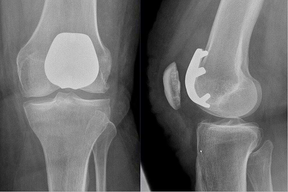 Gelenkprothese retropatellar. Der patellare Anteil ist nicht röntgendicht.