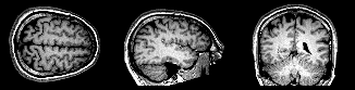 Early Menopause Linked to Faster Alzheimer's Onset and Brain Decline