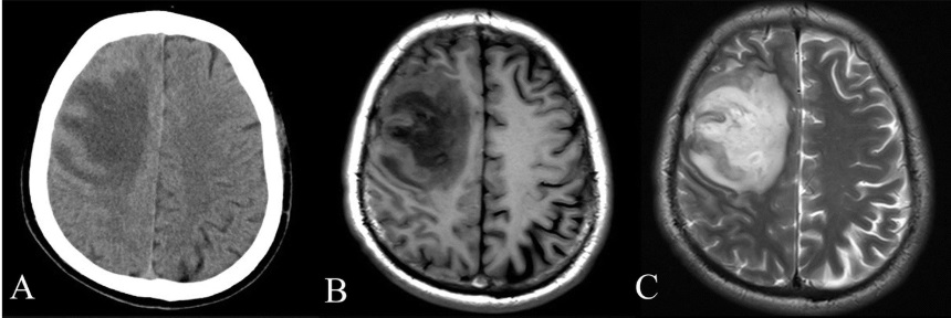 A: CT scan of the brain showing hypodensity of the left frontal lobe of the brain
B: T1-weighted MRI scan of the same brain showing hypointensity of the lesion

C: T2-weighted MRI scan of the same brain showing hyperintensity of the lesion
