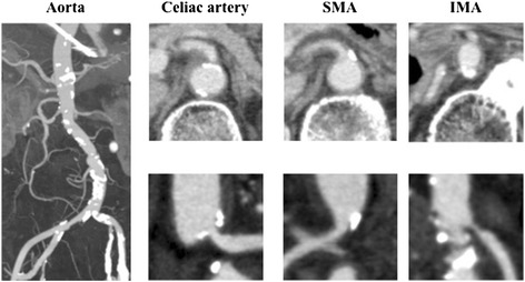 Enhanced computed tomography showing severe atherosclerosis of the arteries. The aorta shows broad calcifications, and the celiac artery shows moderate stenosis, although the lumen of the superior mesenteric artery was relatively patent. In addition, stenosis of the inferior mesenteric artery was ve