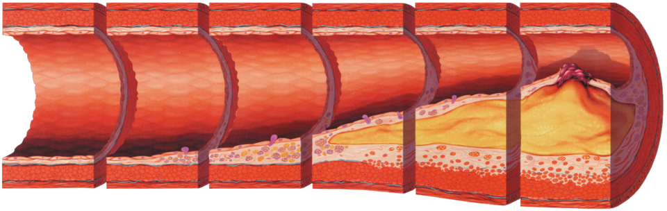 REACT Study Finds Silent Artery Disease Common Across All Adult Age Groups