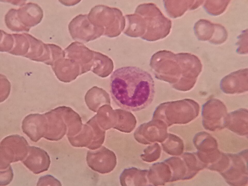 In a Wright-stained peripheral blood smear (PBS) microscopy, neutrophils are one of the types of white blood cells (leukocytes) that can be identified. Neutrophils are the most abundant type of white blood cells and play a crucial role in the body's immune response to infections.