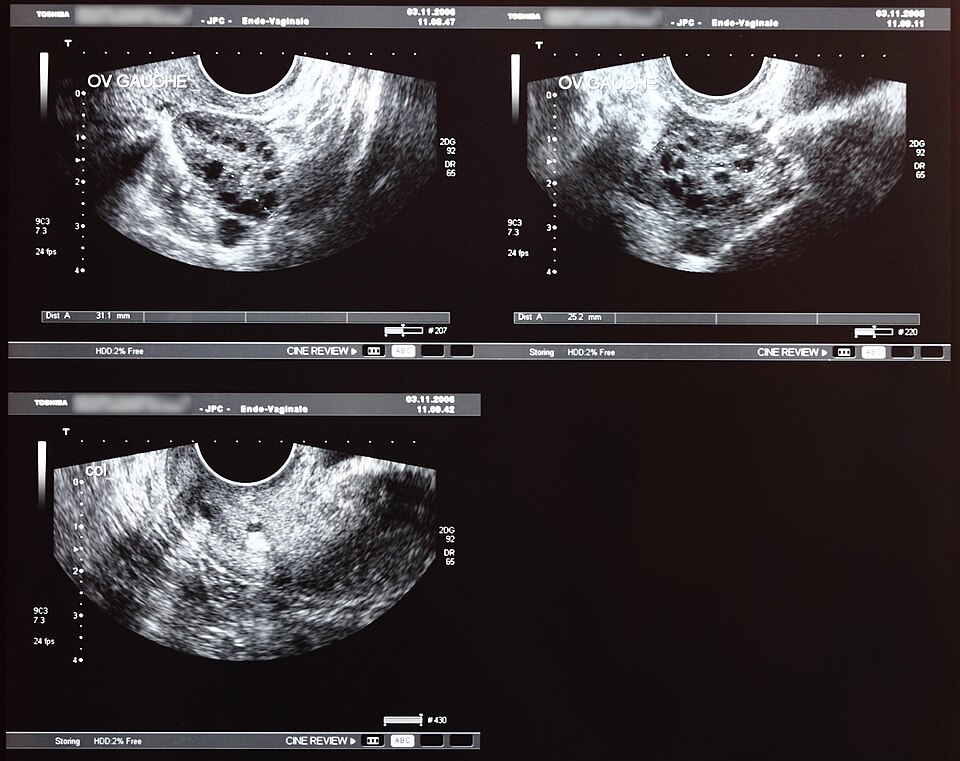 PCOS Name Change to PMOS Reflects Whole-Body Nature of Condition
