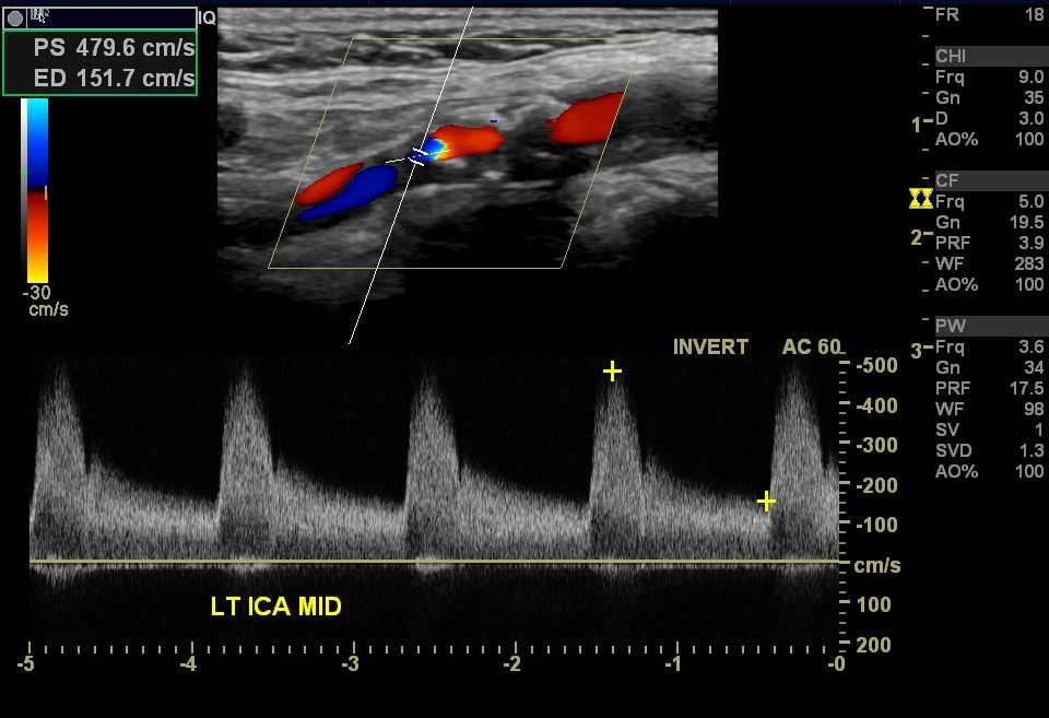 internal carotid artery stenosis in ultrasound; near occlusion