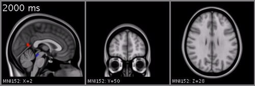 ADHD Brain Patterns May Also Drive Creative Thinking, New Research Finds