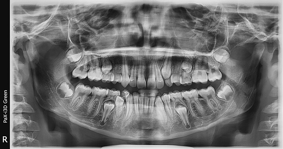Orthopantomogram of a mixed dentition patient with curved root