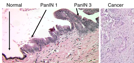Palladin Expression in Primary Cultures of Pancreatic Ductal Cells Derived from Increasingly Neoplastic Samples. Expression of Palladin RNA increases relative to the degree of precancer to cancer: normal to PanIN 1 (hyperplasia) to PanIN 3 (carcinoma in situ) to cancer. Each bar represents epithelia