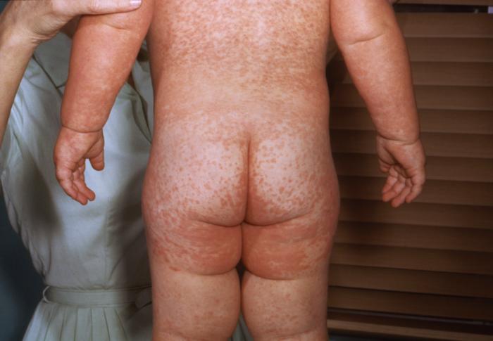 ID#: 4497 
Description: This child with measles is showing the characteristic red blotchy rash on his buttocks and back during the 3rd day of the rash.
Measles is an acute, highly communicable viral disease with prodromal fever, conjunctivitis, coryza, cough, and Koplik spots on the buccal mucosa. A