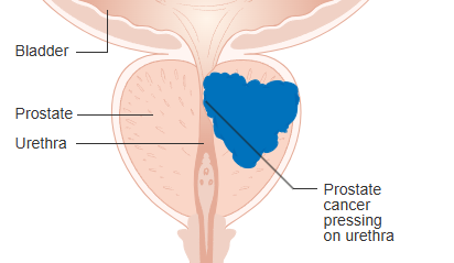 Diagram showing prostate cancer pressing on the urethra.