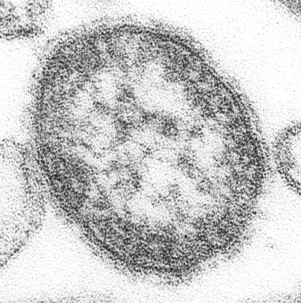 Pennsylvania Woman Dies From Measles Complications