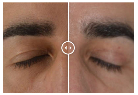 Blefaroplastia-superior-antes-despues