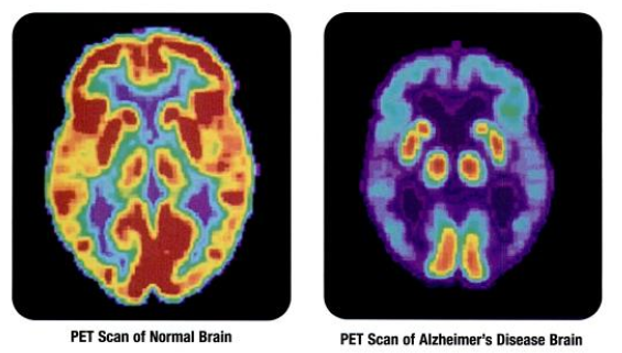 Blood Proteins May Help Doctors Track Alzheimer’s Treatment