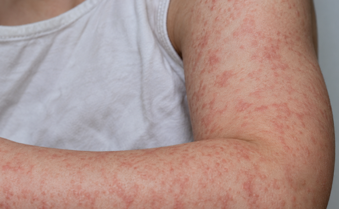 Measles Outbreak Spreads Across Pennsylvania Amid Travel Concerns